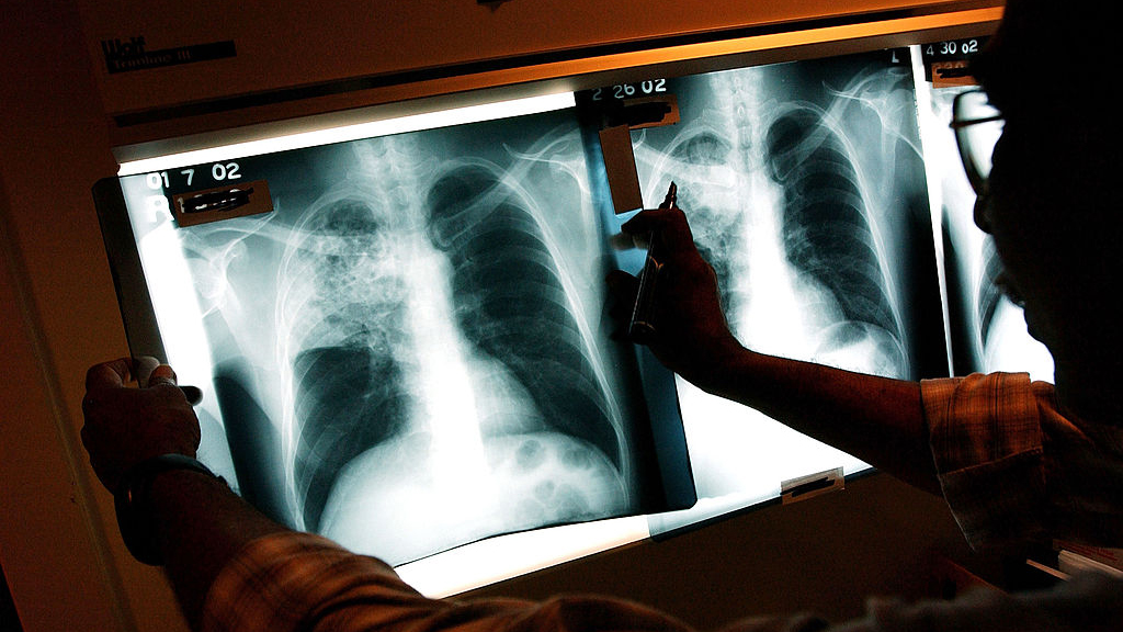 2 active tuberculosis cases traced to San Francisco strip club — KTVU FOX 2 Bay Area, Tiburon Health news